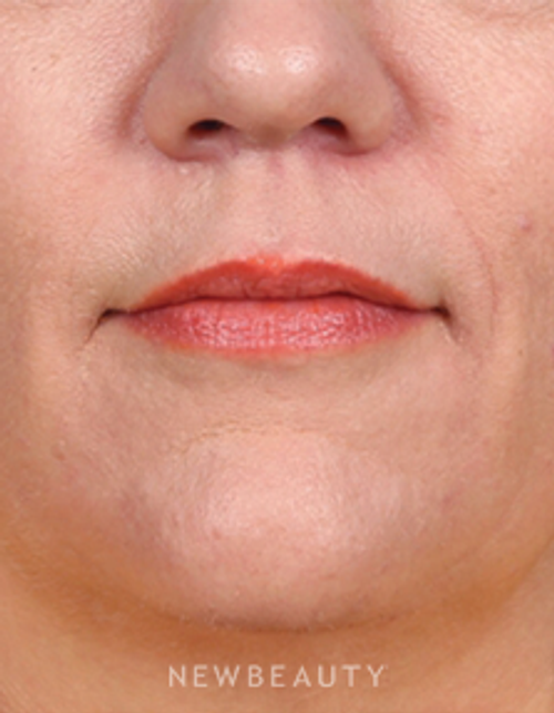 Dr. Kelly Bomer - Lip Enhancement - Before