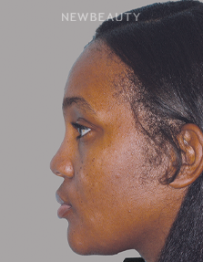 Dr. Anthony Bared - Rhinoplasty - 46164771 - Before