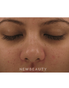 Dr. Jody Levine - Lasers - Before