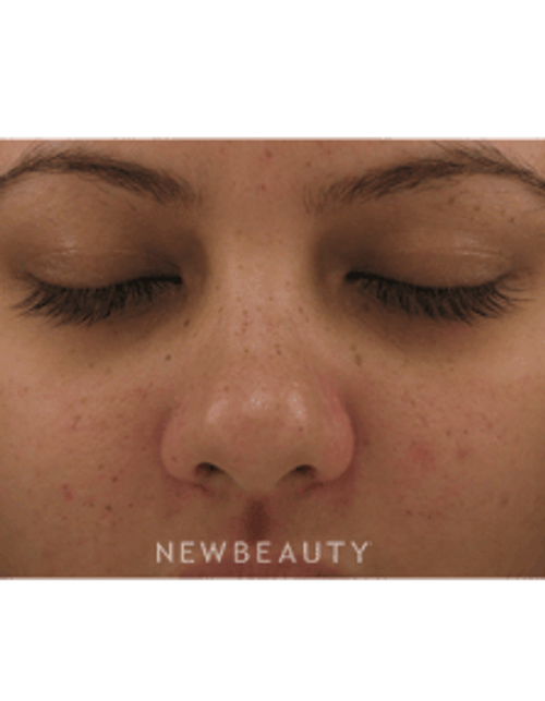 Dr. Jody Levine - Lasers - Before