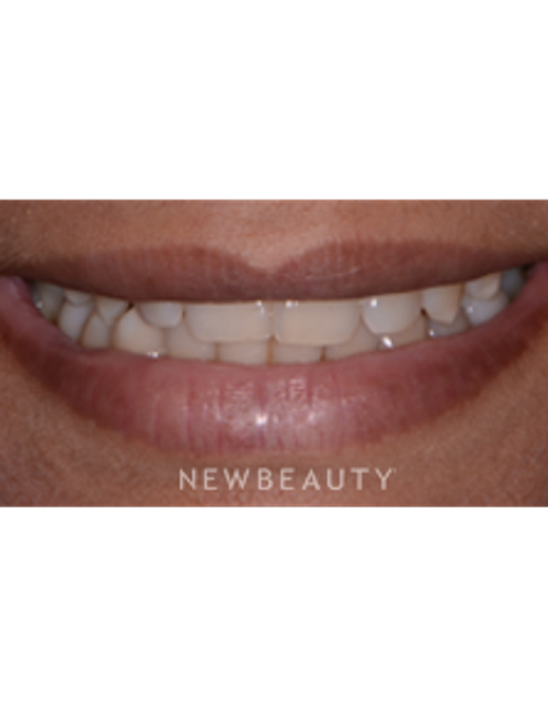Dr. Irene Grafman - Cosmetic Bonding - Before