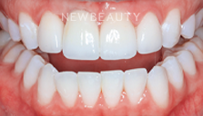 Dr. Joseph Field - Veneers - 20258382 - After