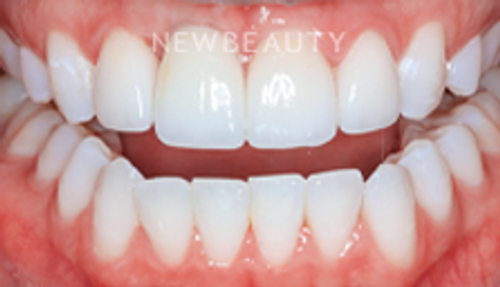 Dr. Joseph Field - Veneers - 20258382 - After