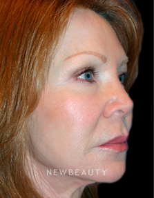 Dr. Kelly Bomer Injectables - After