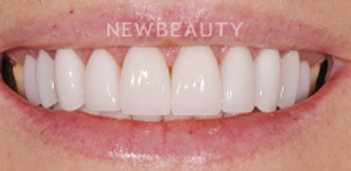 Dr. Salvator La Mastra - Smile Makeover -46106673 - After