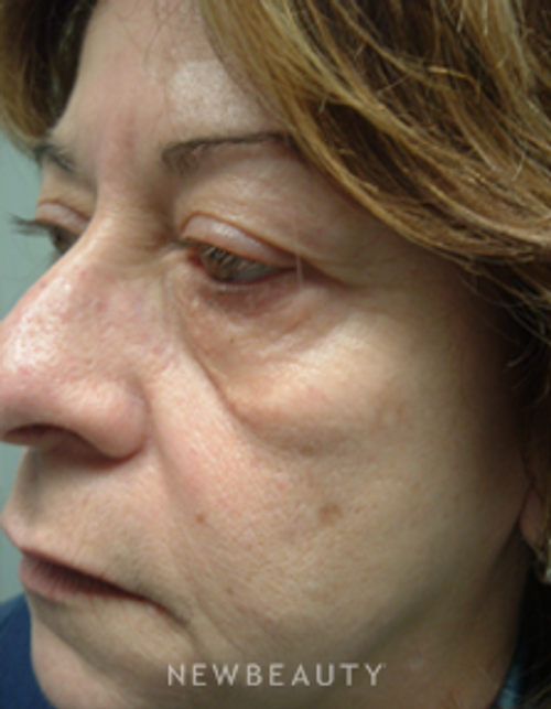Dr. Marina Peredo Elos Injections/Liquid Lift - Before
