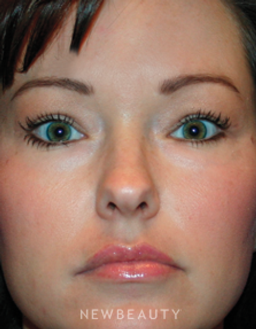 Dr. Kelly Bomer - Upper Blepharoplasty - After