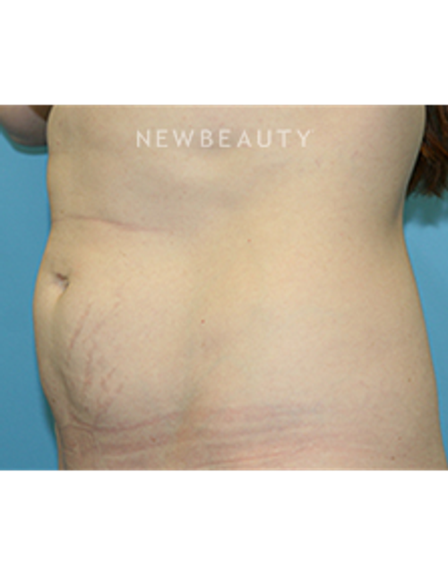 Dr. Christine Hamori - Liposuction - Before