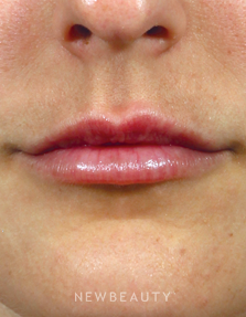 Dr. Kenneth R. Beer - The Art of Lip Enhancement - After