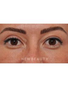 Dr. Edward Kwak - Upper Blepharoplasty - After