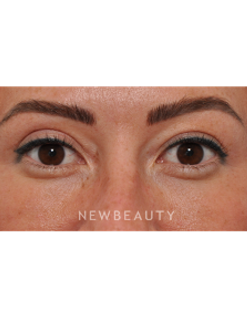 Dr. Edward Kwak - Upper Blepharoplasty - After