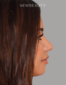 Dr. Anthony Bared - Refined Elegance - 44696946 - After