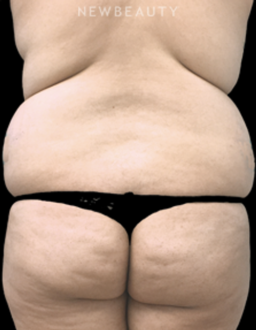 Dr. Kirk Churukian - VASER Lipo - Before