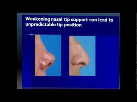 Dr. David Kim – Rhinoplasty – The Structural Approach To Rhinoplasty – Part 7