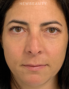 Dr. Dilip Madnani - Upper and Lower Blepharoplasty - 13691651 - After