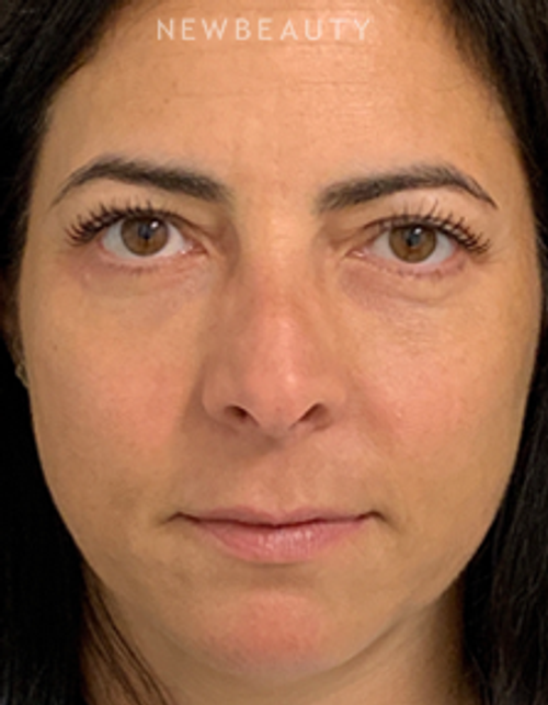Dr. Dilip Madnani - Upper and Lower Blepharoplasty - 13691651 - After