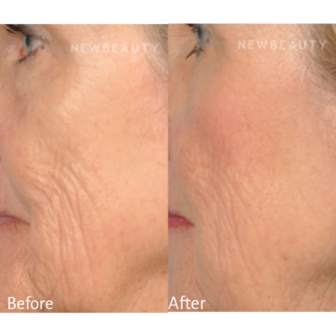 Microneedling before and after Image / Bengtson