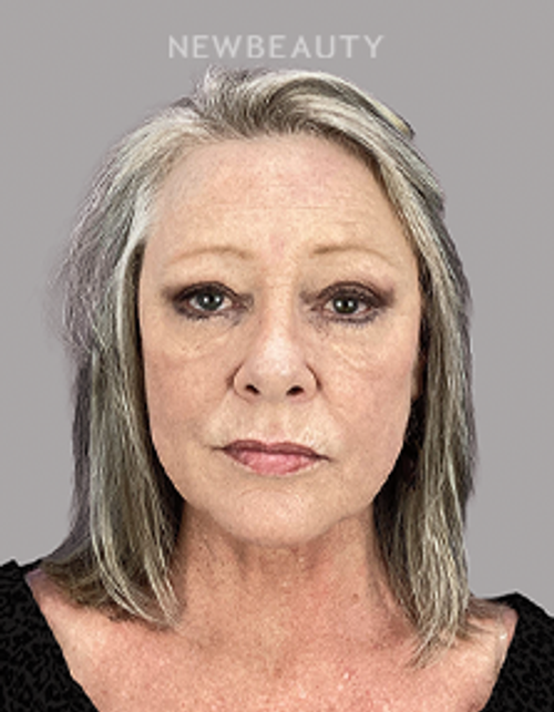 Dr. Sheila Barbarino-Lower Blepharoplasty, Upper Blepharoplasty-54799251 - After