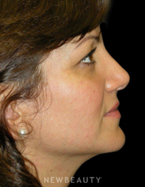 Dr. Elie Levine - Rhinoplasty - After