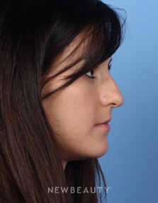 Dr. Kelly Bomer - Rhinoplasty - Before