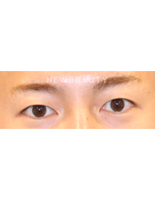 Dr. Lily Lee - Upper Blepharoplasty - Before