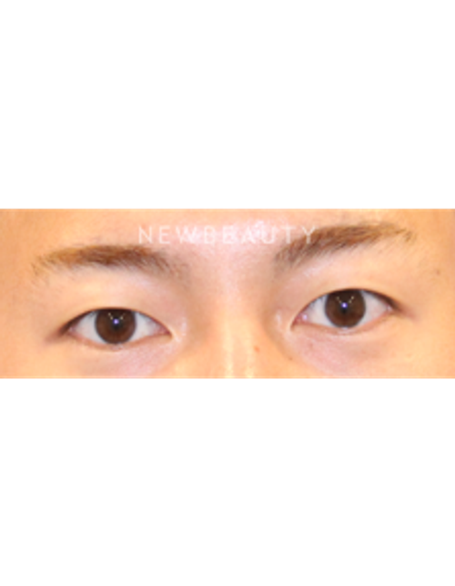 Dr. Lily Lee - Upper Blepharoplasty - Before
