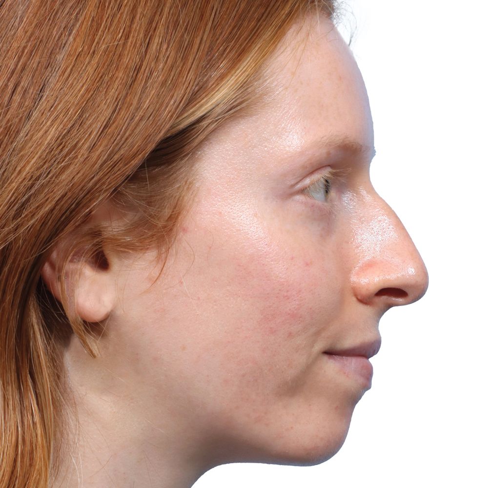 Rhinoplasty Before