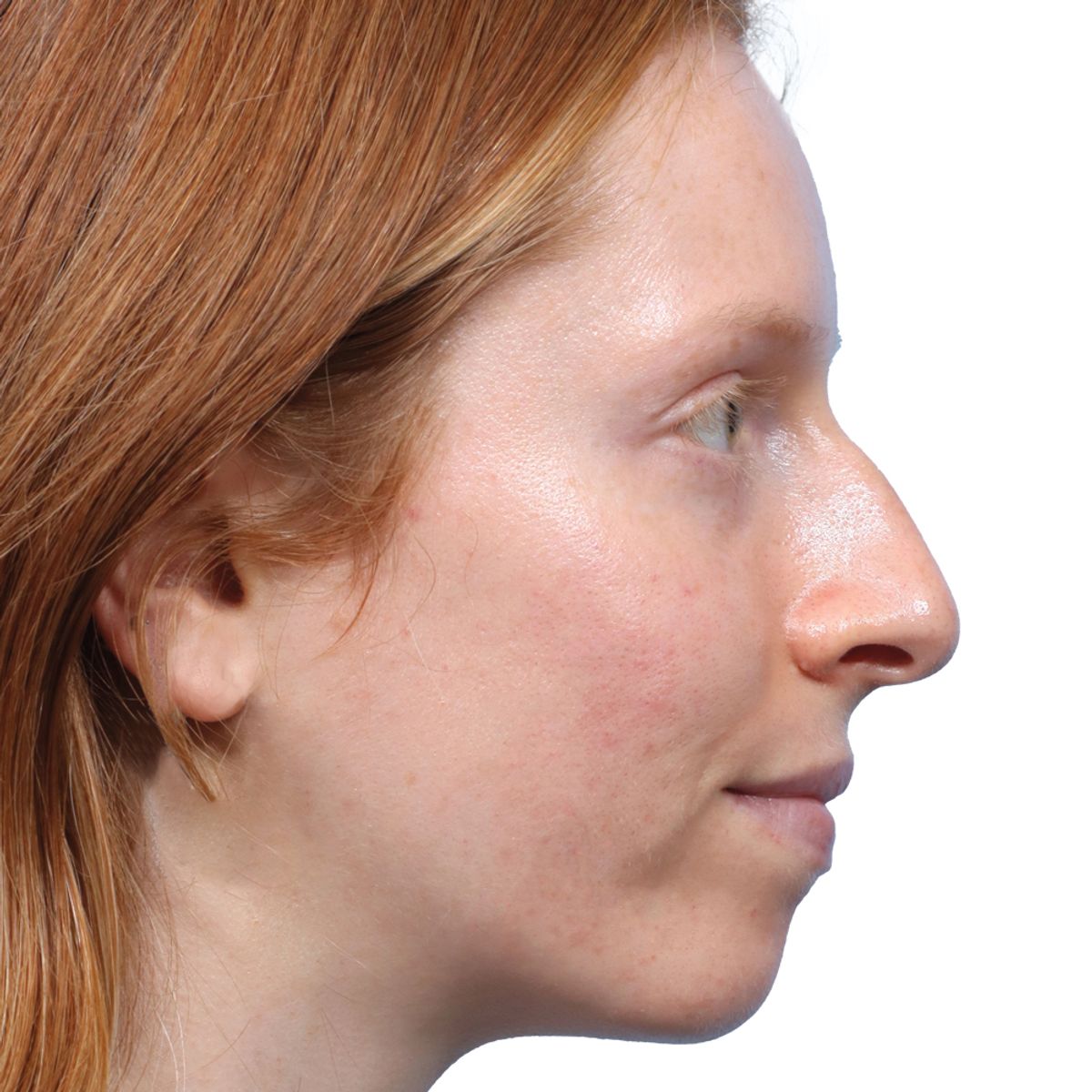 Rhinoplasty Before