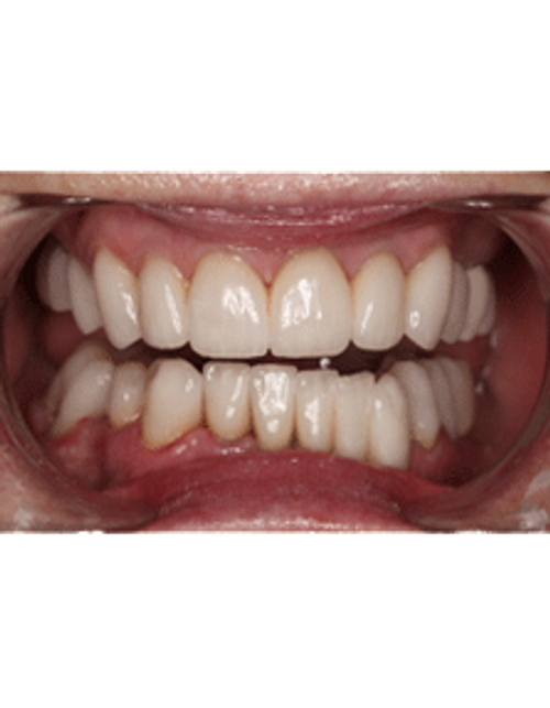 Dr. Neal Patel Smile Makeover - After