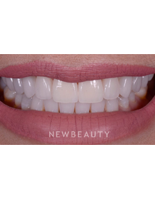 Dr. Husam Almunajed - Smile Makeover - After