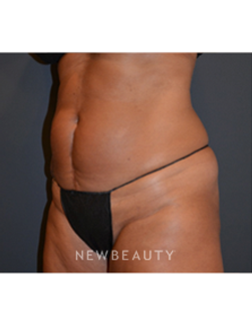 Dr. Aviva Preminger - CoolSculpting - After