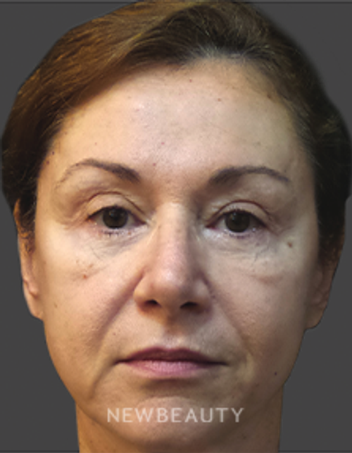 Dr. Deborah Longwill - Facial Rejuvenation - Before