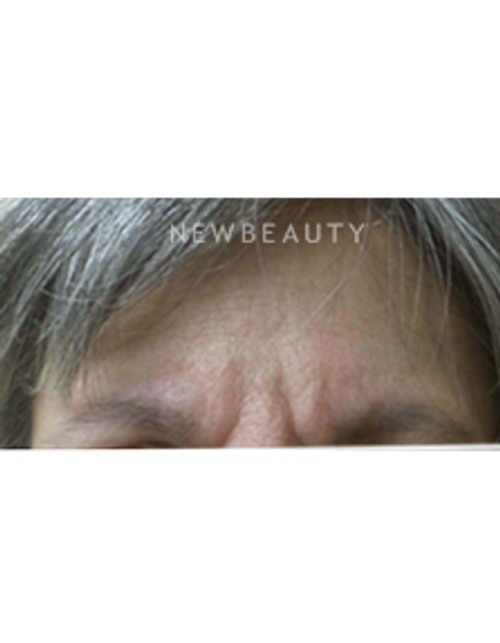 Dr. Kally Papantoniou - Injectables and Fillers - Before
