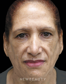 Dr. Jody Levine Injectables and Fillers - Before