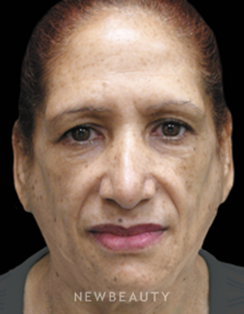 Dr. Jody Levine Injectables and Fillers - Before