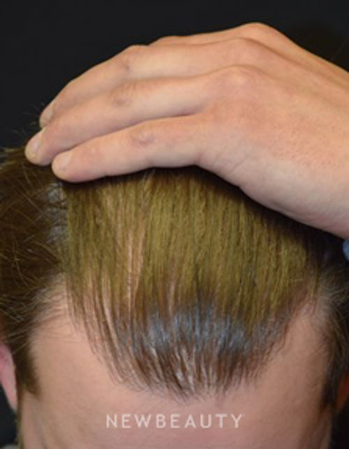 Dr. Jeffrey B. Wise - Hair Transplant - After
