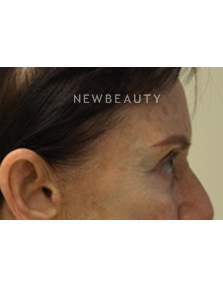 Dr. Julie Russak - Liquid Facelift - Before