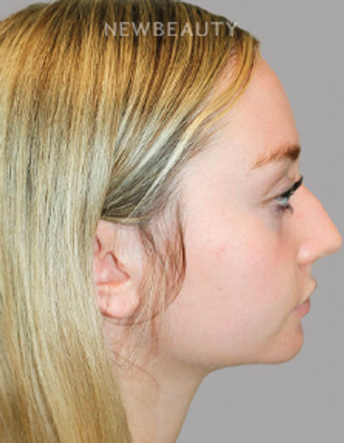 Dr. Sanjay Grover - Rhinoplasty - 49727960 - Before