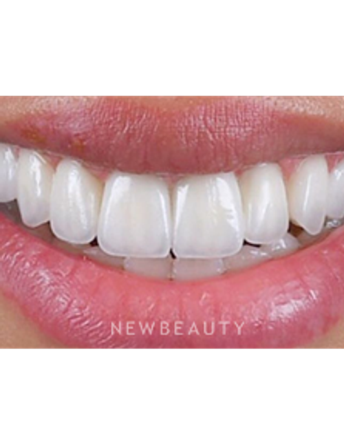Dr. Husam Almunajed - Smile Makeover - After