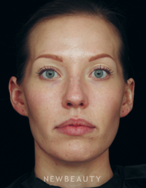 Dr. Jennifer Segal Browlift, Cheek Augmentation, Lip Enhancement, Non-surgical Rhinoplasty - Before