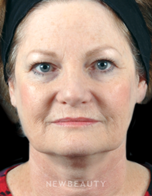 Dr. Bradley Bengtson - Facial Rejuvenation - Before