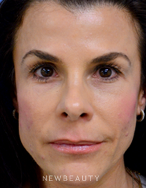 Dr. Mokhtar Asaadi - Matching Aesthetics - After