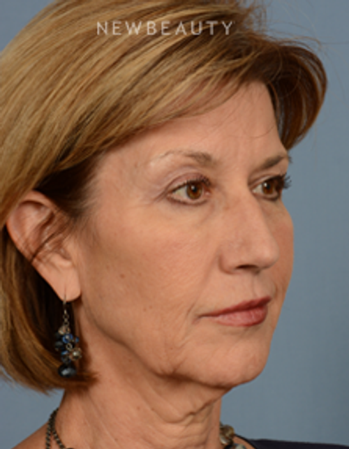 Dr. Bryan W. Gawley - Facial Rejuvenation - Before