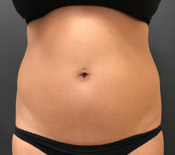 Dr. Janet Allenby - CoolSculpting - Before