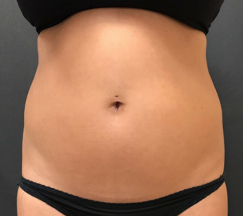 Dr. Janet Allenby - CoolSculpting - Before