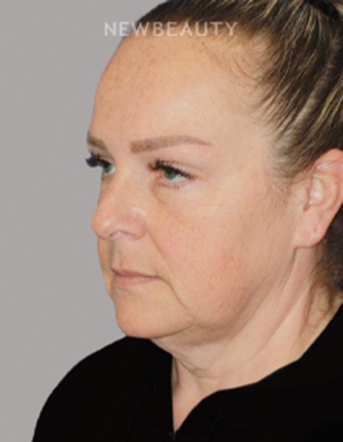 Dr. Konstantin Vasyukevich – Deep Plane Face and Neck Lift – 46903849 - Before