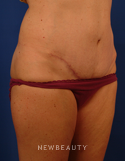 Dr. Peter Geldner Abdominoplasty - After