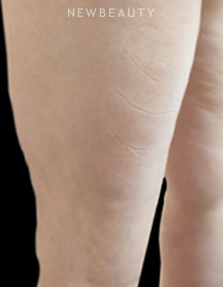Dr. Jody Levine - Sclerotherapy - After