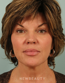 Dr. Kenneth Beer Injectables & Fillers, Restylane - Before