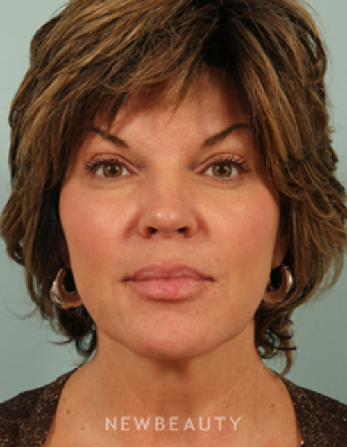 Dr. Kenneth Beer Injectables & Fillers, Restylane - Before